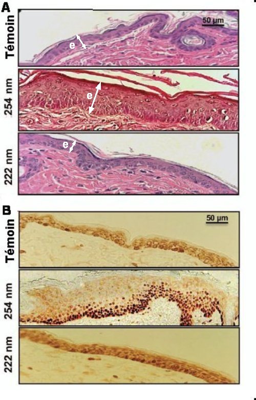 Fig.1. Epaisseur de l’épiderme et prolifération des kératinocytes dans la peau de souris exposée à la lumière UVC. A)Coupes de la peau du dos de souris montrant l’épaisseur (e) de l’épiderme dans le cas d’une souris témoin (en haut) non exposée aux UV, d’une souris ayant reçu 157 milli-joules/cm2 d’UVC de 254 nm (au milieu) et dans celui d’une souris ayant reçu la même insolation à 222 nm (en bas). L’épaisseur de l’épiderme est 3 fois plus grande dans la coupe du milieu (254 nm) que dans les 2 autres, où elle est égale. B) Kératinocytes (cellules teintes en brun fonçé) présentes dans les coupes de peau de souris dans les mêmes conditions d’insolation qu’en A. La densité de kéranocytes est 2,5 fois plus élevée dans la microphoto du milieu (254 nm) que dans les 2 autres. Tiré de Germicidal Efficacy and Mammalian Skin Safety of 222-nm UV Light Manuela Buonanno, Brian Ponnaiya, David Welch, Milda Stanislauskas, Gerhard Randers-Pehrson, Lubomir Smilenov, Franklin D. Lowy, David M. Owens, and David J. Brenner Radiat. Res. Author manuscript; available in PMC 2017 August 10. Avec l’aimable autorisation de David J. Brenner.